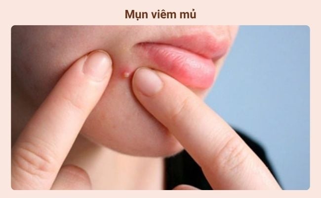 Mụn viêm mủ