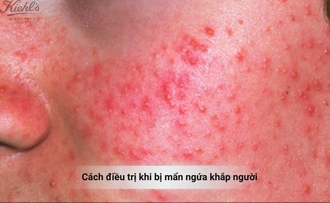 Bị mẩn ngứa khắp người phải làm sao