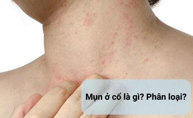 Việc hiểu rõ phân loại mụn ở cổ sẽ giúp bạn chọn phương pháp điều trị hiệu quả nhất.