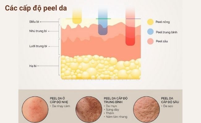 Các cấp độ peel da bạn cần biết