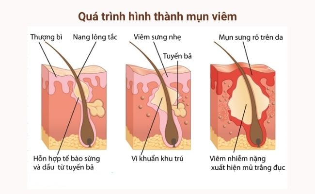 Quá trình hình thành mụn viêm