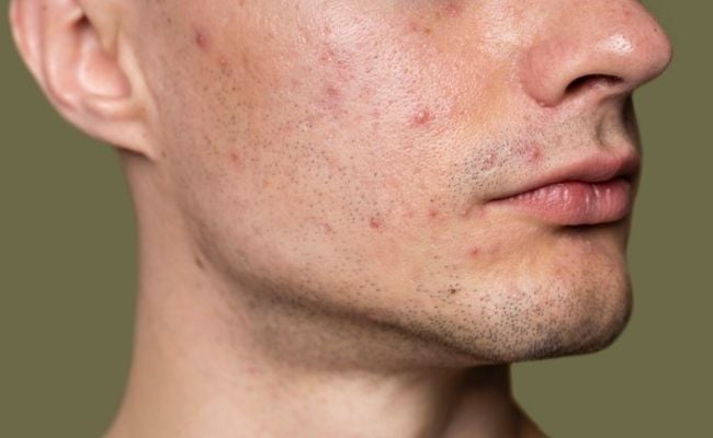 Da dầu ở nam giới: Đặc điểm & nguyên nhân

