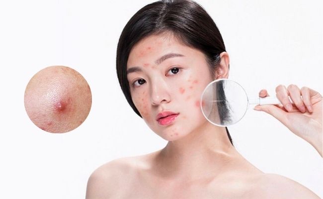 Da mụn có nên dùng kem chống nắng không?