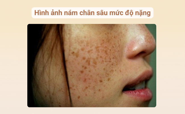 Hình ảnh bị nám chân sâu nặng