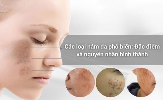 Hình ảnh minh họa về các loại nám da