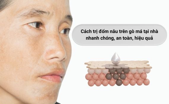 Hình ảnh minh họa về cách trị đốm nâu trên gò má