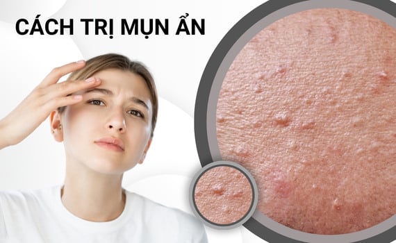 Hình ảnh minh họa về Cách trị mụn ẩn