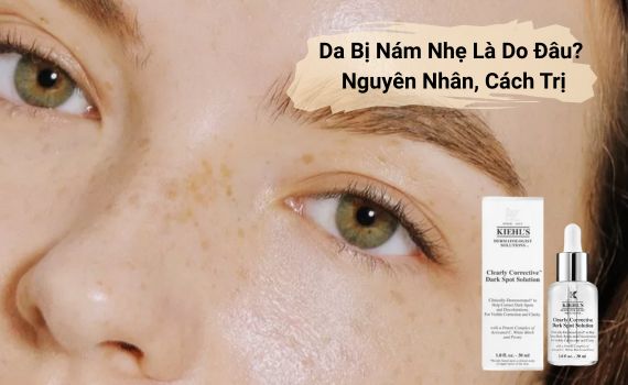Hình ảnh minh họa về da bị nám nhẹ
