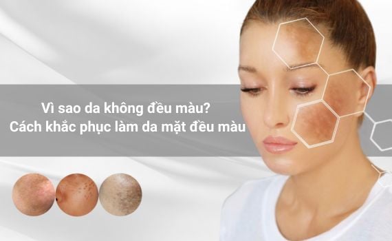 Hình ảnh minh họa về da không đều màu