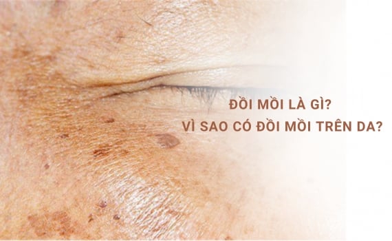Hình ảnh minh họa về đồi mồi