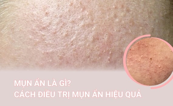 Hình ảnh minh họa về Mụn ẩn