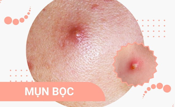 Hình ảnh minh họa về mụn bọc