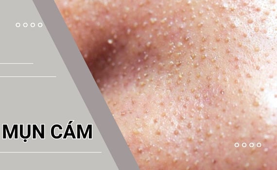 Hình ảnh minh họa về Mụn cám