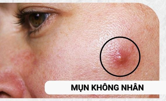 Hình ảnh minh họa về mụn không nhân