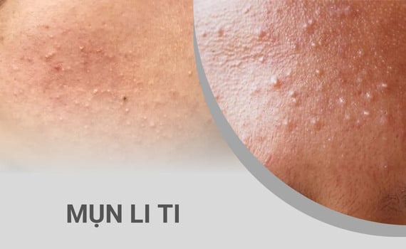 Hình ảnh minh họa về mụn li ti