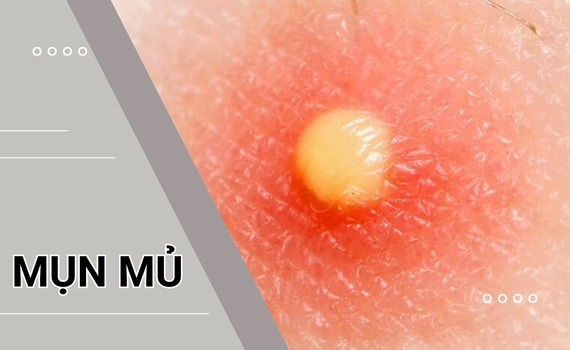 Hình ảnh minh họa về mụn mủ