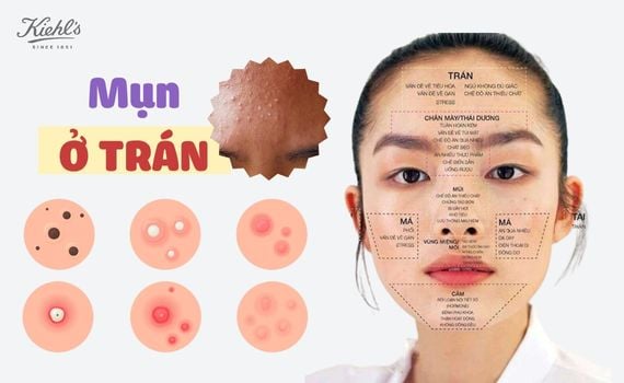 Hình ảnh minh họa về Mụn ở trán