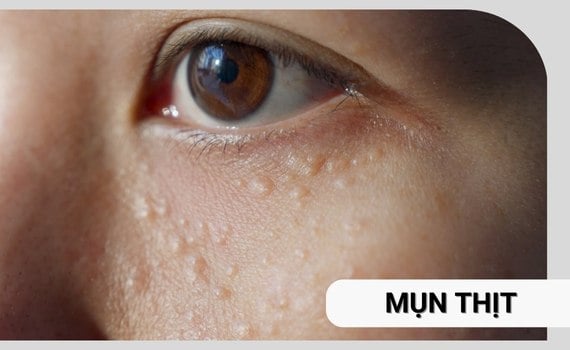 Hình ảnh minh họa về Mụn thịt