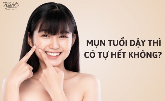 Hình ảnh minh họa về mụn tuổi dậy thì có tự hết không