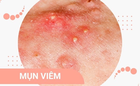Hình ảnh minh họa về mụn viêm