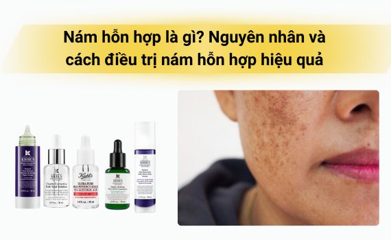 Hình ảnh minh họa về nám hỗn hợp
