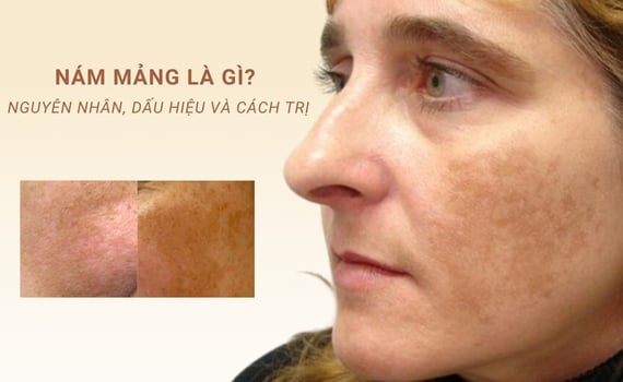 Hình ảnh minh họa về nám mảng
