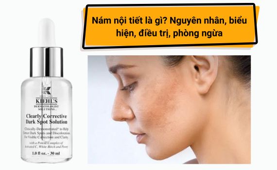 Hình ảnh minh họa về nám nội tiết