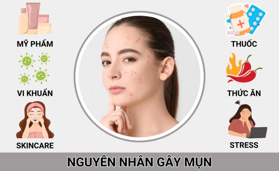 Hình ảnh minh họa về nguyên nhân gây mụn
