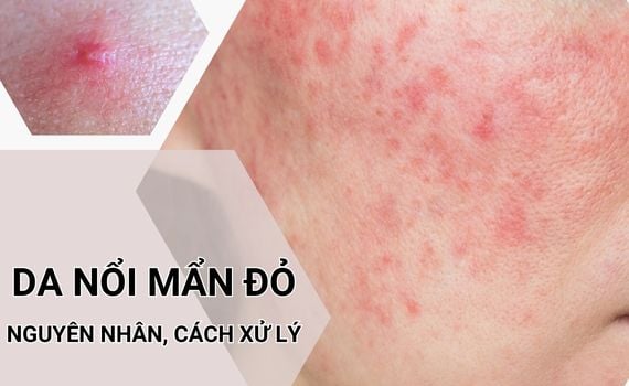Hình ảnh minh họa về nổi mẩn đỏ