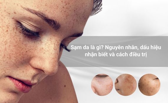 Hình ảnh minh họa về Sạm Da