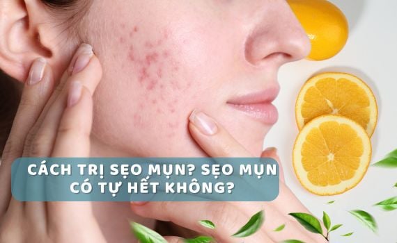Hình ảnh minh họa về sẹo mụn