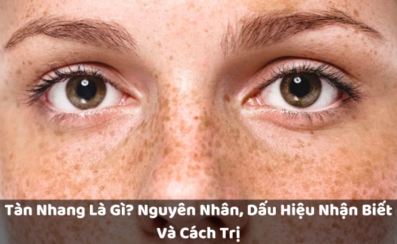 Hình ảnh minh họa về tàn nhang