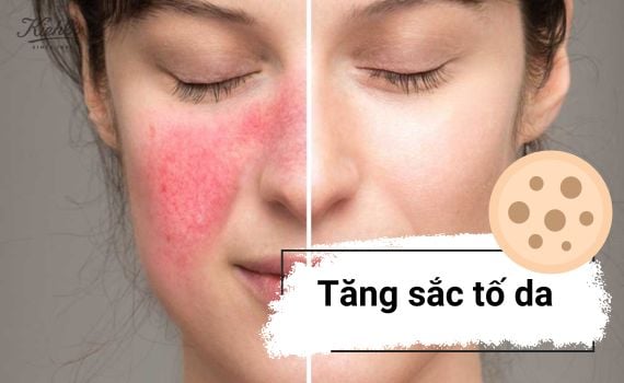Hình ảnh minh họa về tăng sắc tố da