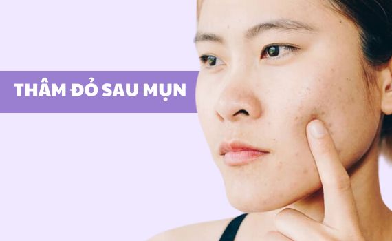 Hình ảnh minh họa về thâm đỏ sau mụn