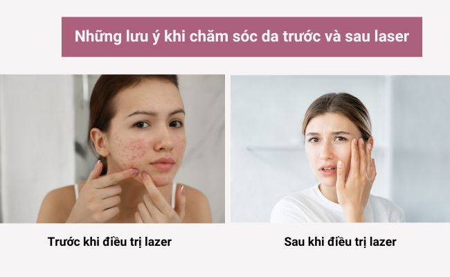 Những lưu ý khi chăm sóc da trước và sau laser