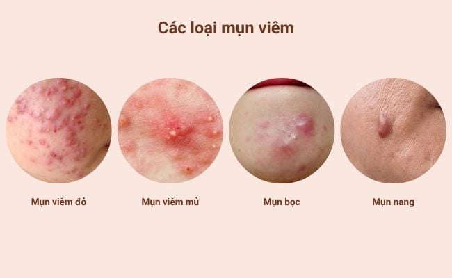 Các loại mụn viêm thường gặp