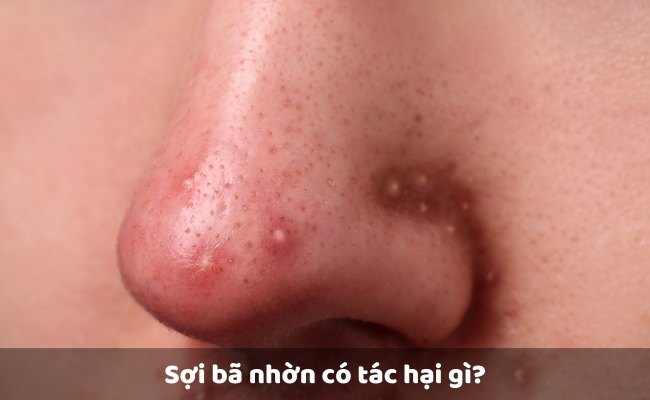 Sợi bã nhờn có tác hại gì?