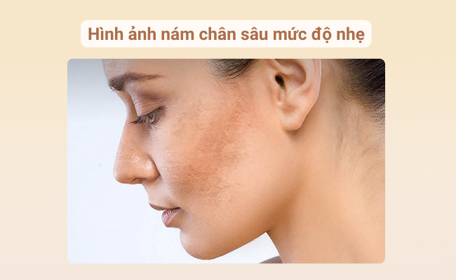 Hình ảnh nám chân sâu nhẹ