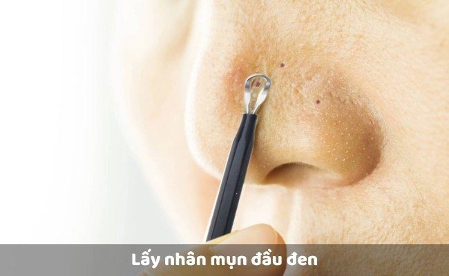 Lấy nhân mụn đầu đen