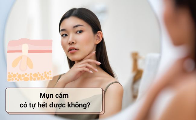 Mụn cám có tự hết được không?