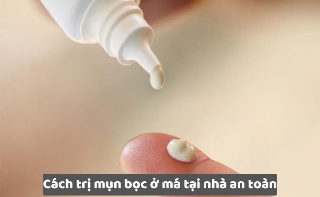 Trị mụn bọc ở má bằng thuốc bôi không kê đơn (OTC)

