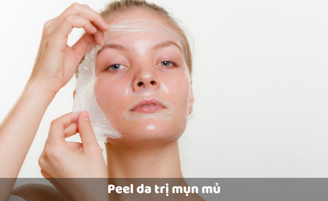 Peel da trị mụn mủ

