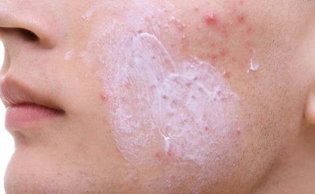 Cách trị mụn tuổi dậy thì bằng Benzoyl peroxide