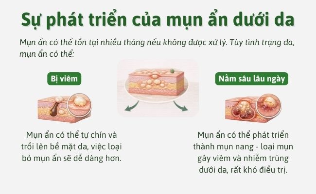 Sự phát triển của mụn ẩn dưới da