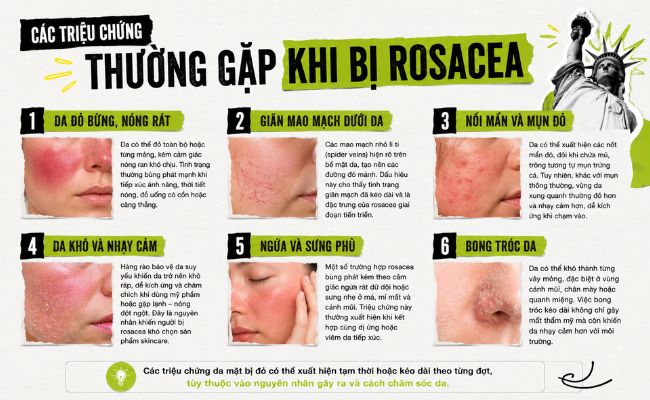 Các triệu chứng thường gặp khi bị Rosacea