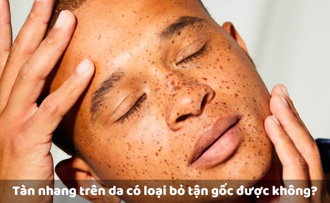 Tàn nhang trên da có loại bỏ tận gốc được không?