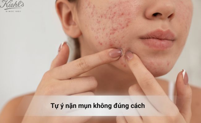 Tự ý nặn mụn không đúng cách