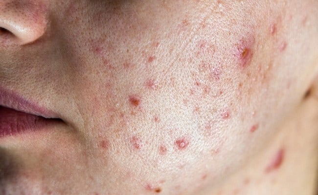 Các yếu tố làm tăng nguy cơ hình thành và phát triển mụn trứng cá