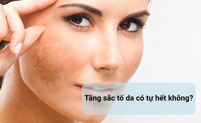 Tăng sắc tố da có tự hết không