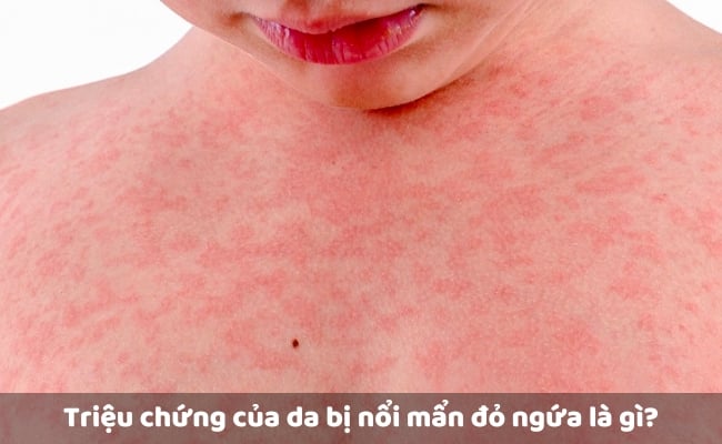 Triệu chứng của da bị nổi mẩn đỏ ngứa là gì?